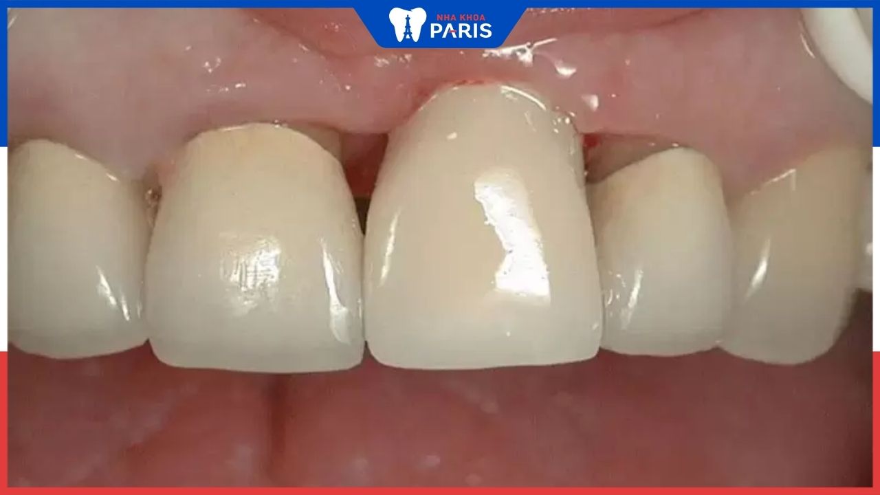 Răng sứ hết hạn sau khi sử dụng bao lâu – 3 dấu hiệu nhận biết